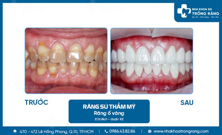 Bọc răng sứ điều chỉnh cho đều răng