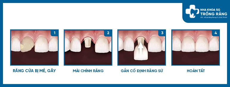 Bọc sứ răng cửa bị mẻ