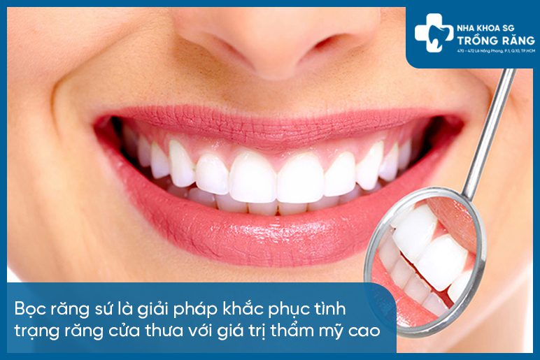 Bọc sứ răng cửa bị thưa