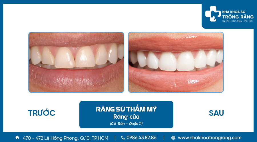 Bọc sứ răng cửa thưa_Cô Trân