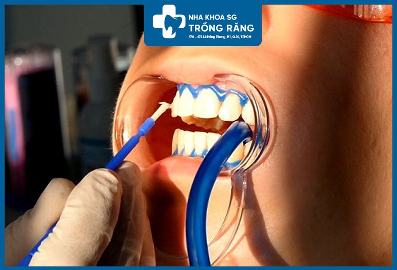 Bôi thuốc tẩy trắng răng
