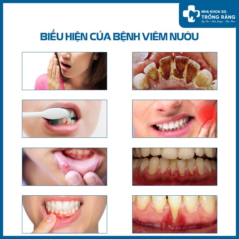 Các biểu hiện của bệnh viêm nướu