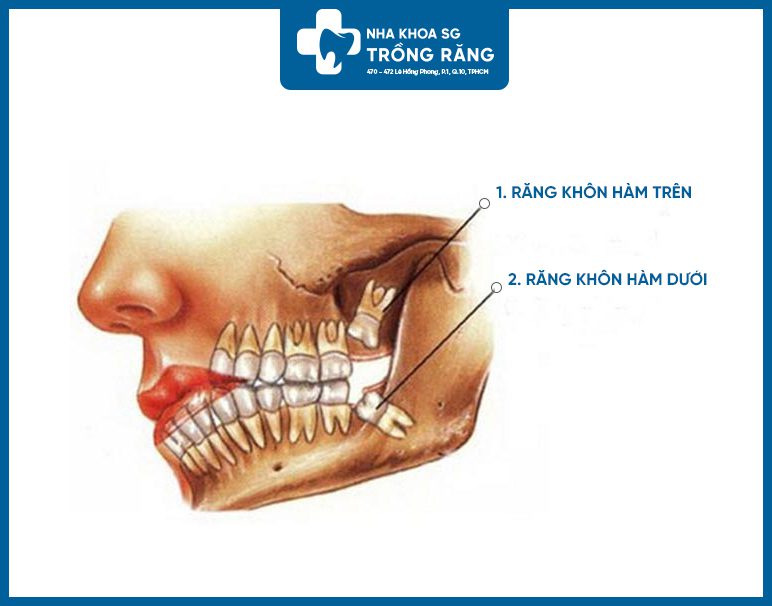 Các dạng mọc răng khôn