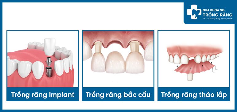 Các giải pháp trồng răng cửa Các giải pháp trồng răng cửa