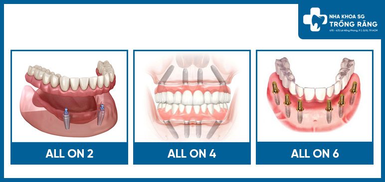 Các hình thức trồng răng implant all on