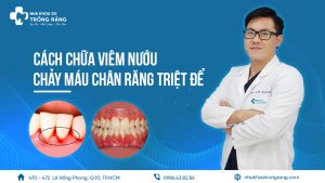 Cách chữa viêm nướu chảy máu chân răng triệt để
