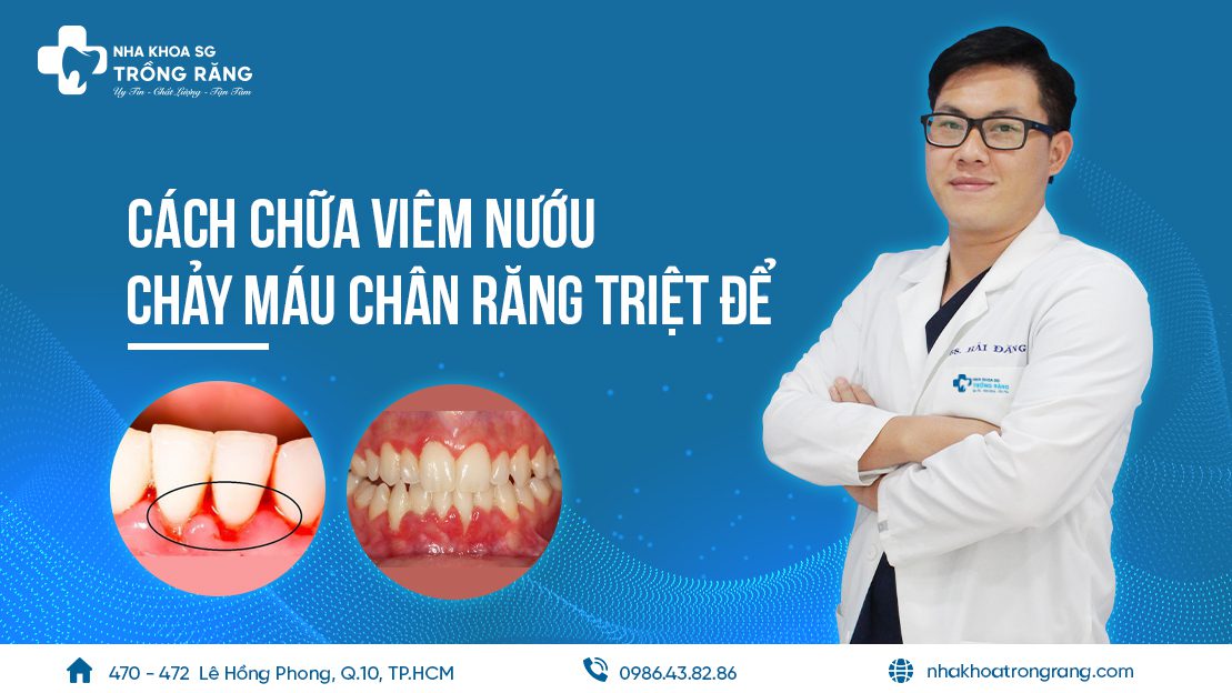 Cách chữa viêm nướu chảy máu chân răng triệt để