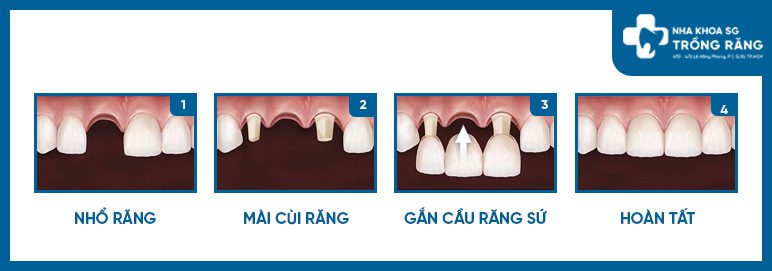 Cách làm răng sứ bắc cầu