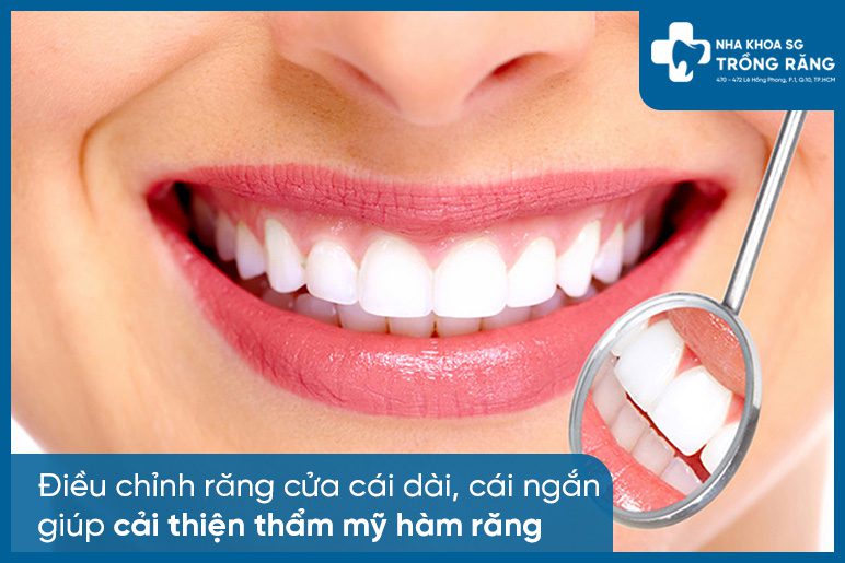 Cải thiện thẩm mỹ hàm răng