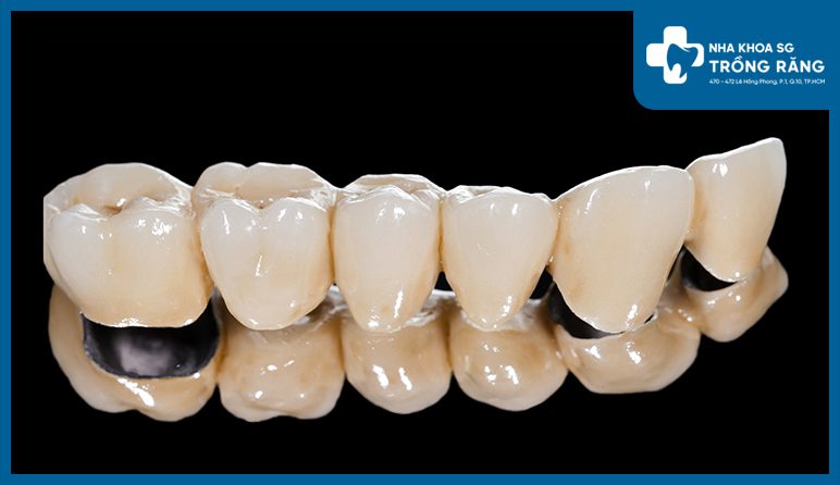 Cầu răng sứ 6 răng