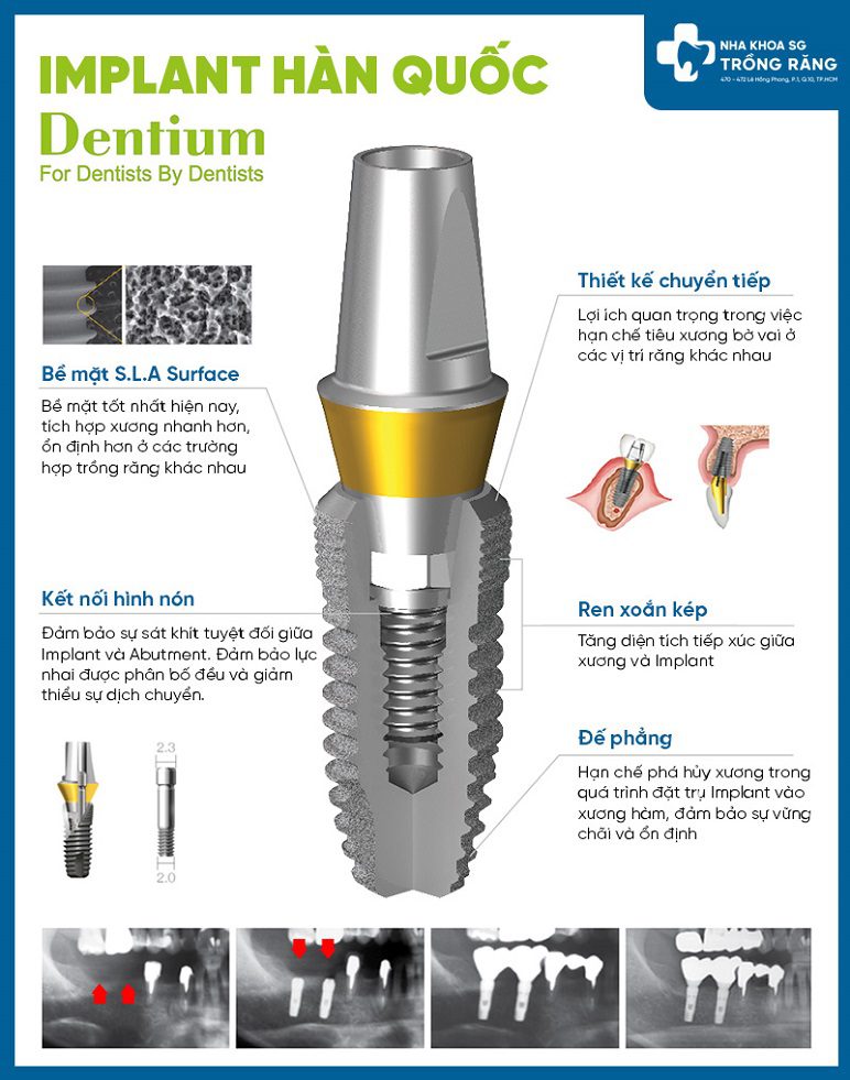Cau tao Implant Han Quoc Dentium