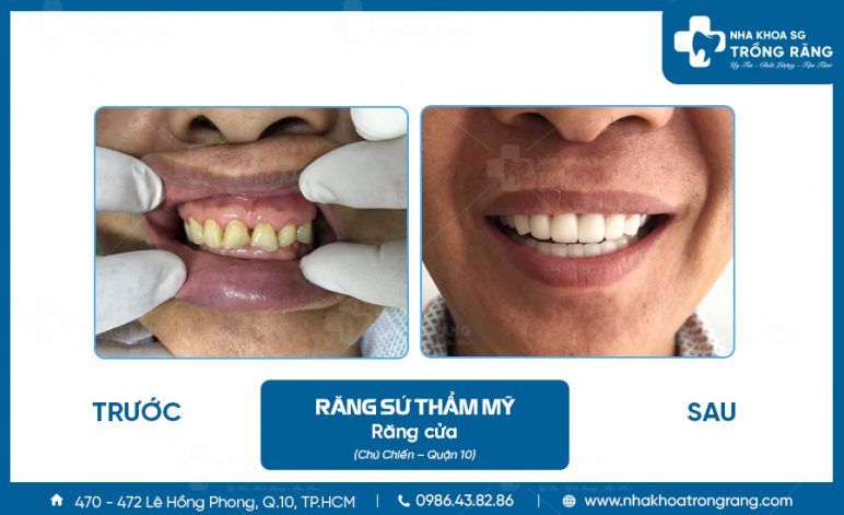 Chú Chiến bọc răng sứ mẻ răng cửa