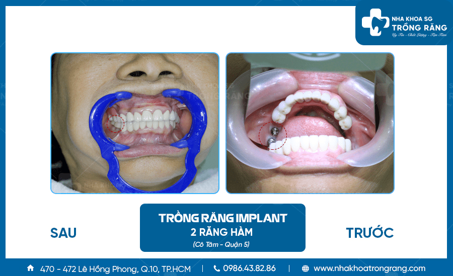 Cô Tâm trồng răng implant sau 15 năm