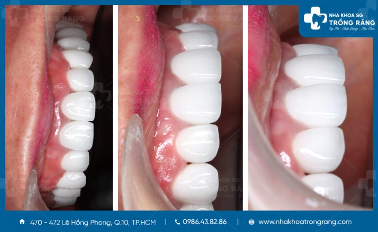 Dán răng sứ thẩm mỹ Emax Press cực đẹp