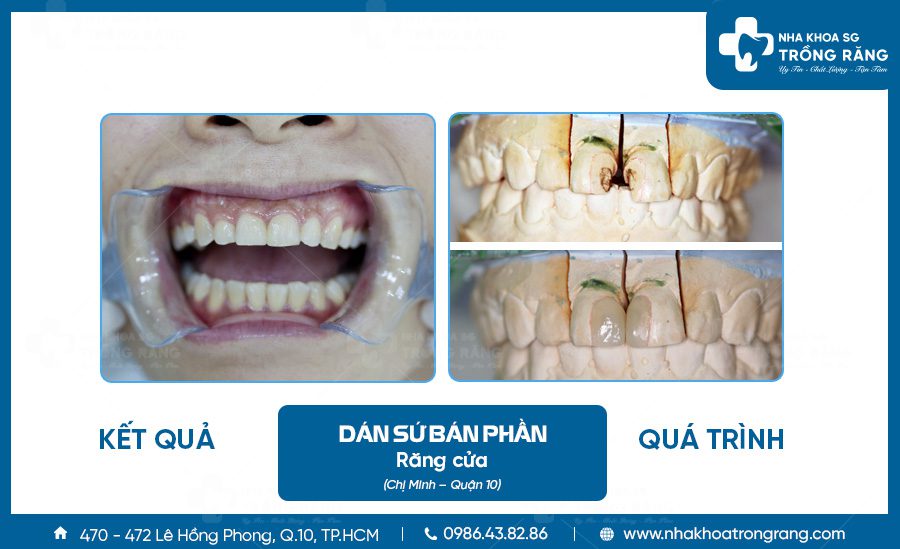 Dán sứ bán phần cho răng cửa thưa