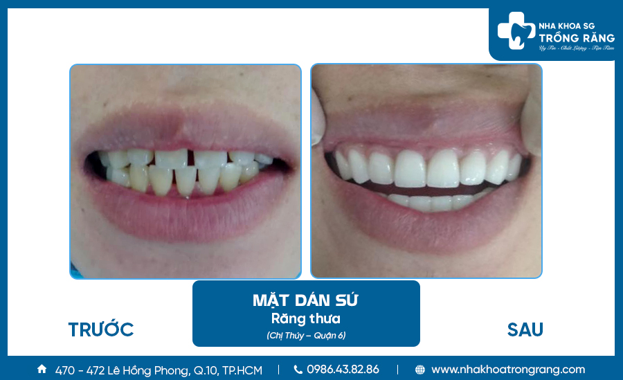 Dán sứ răng cửa bị thưa