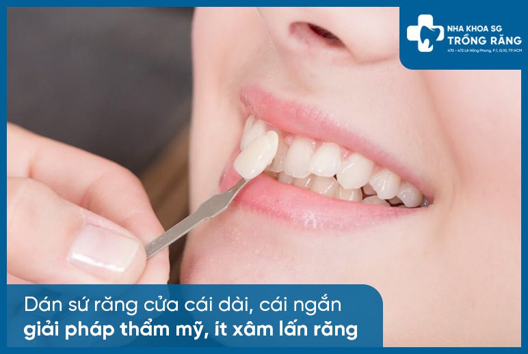 Dán sứ răng cửa