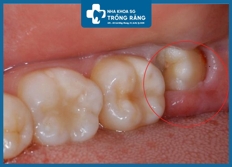 Dấu hiệu Răng khôn mọc lệch