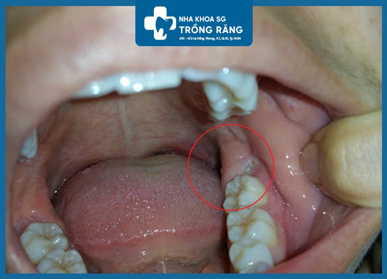 Dấu hiệu Răng khôn mọc ngầm