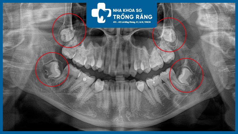 Dấu hiệu mọc răng khôn ngầm film xuang