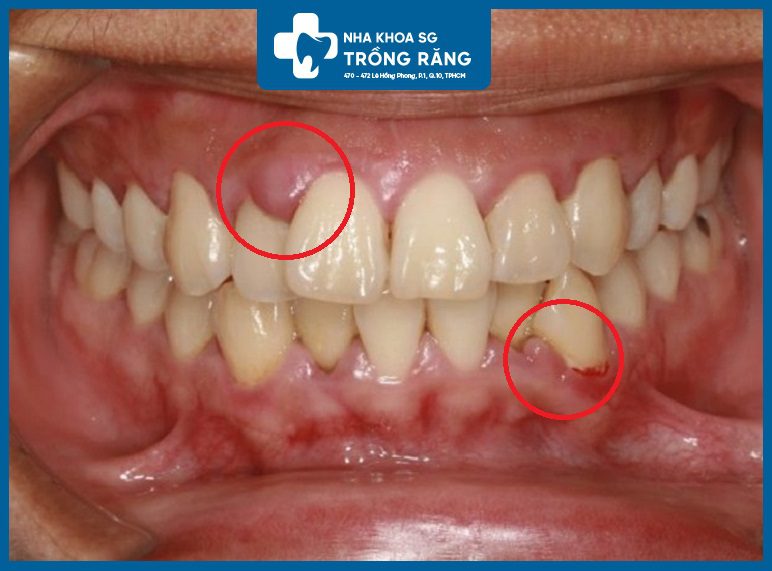 Dau hieu sung nuou Dấu hiệu sưng nướu