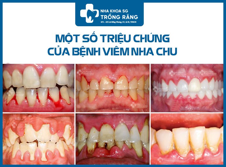 Dấu hiệu viêm nha chu