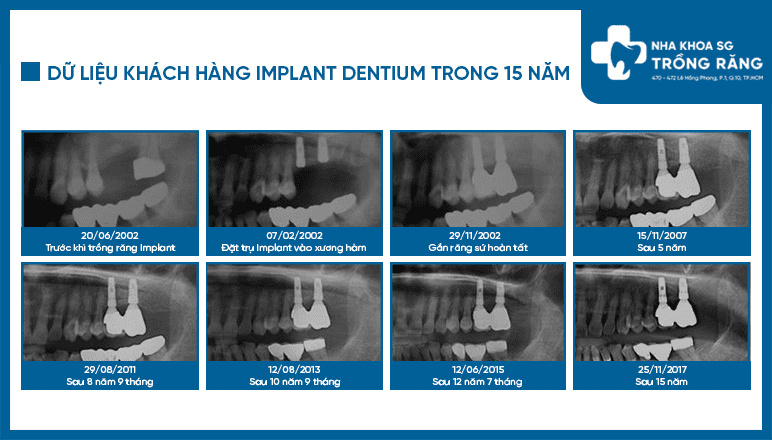 Vệ sinh implant đúng cách giúp duy trì tuổi thọ răng implant
