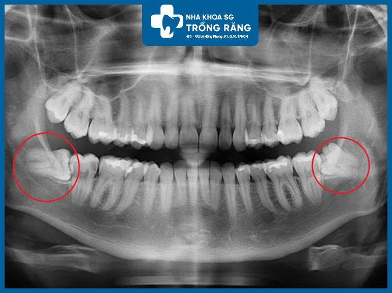 Film Xquang răng khôn mọc lệch