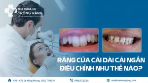 Giải pháp điều chỉnh răng cửa dài ngắn lệch nhau