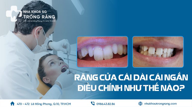 Giải pháp điều chỉnh răng cửa dài ngắn lệch nhau