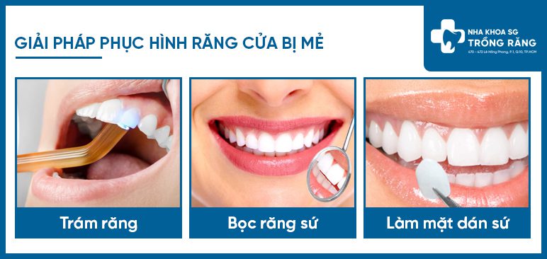Giải pháp khắc phục răng cửa mẻ