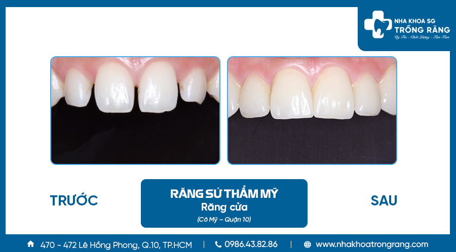 Hình ảnh Bọc sứ răng cửa thưa