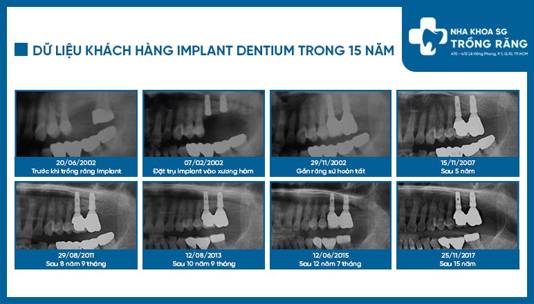 Hình ảnh khách hàng cắm ghép implant hàn quốc sau 15 năm