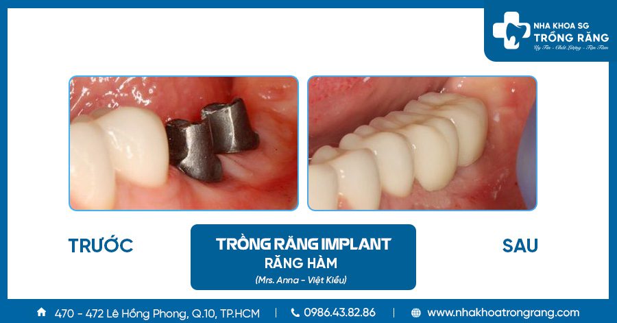 Hình ảnh trồng răng vĩnh viễn implant