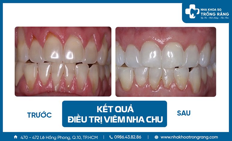 Ket qua dieu tri nha chu