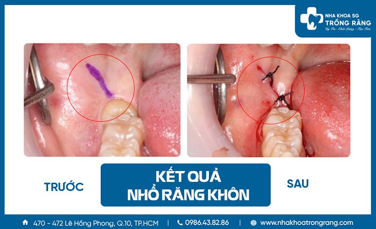 Ket qua nho rang khon Kết quả nhổ răng khôn