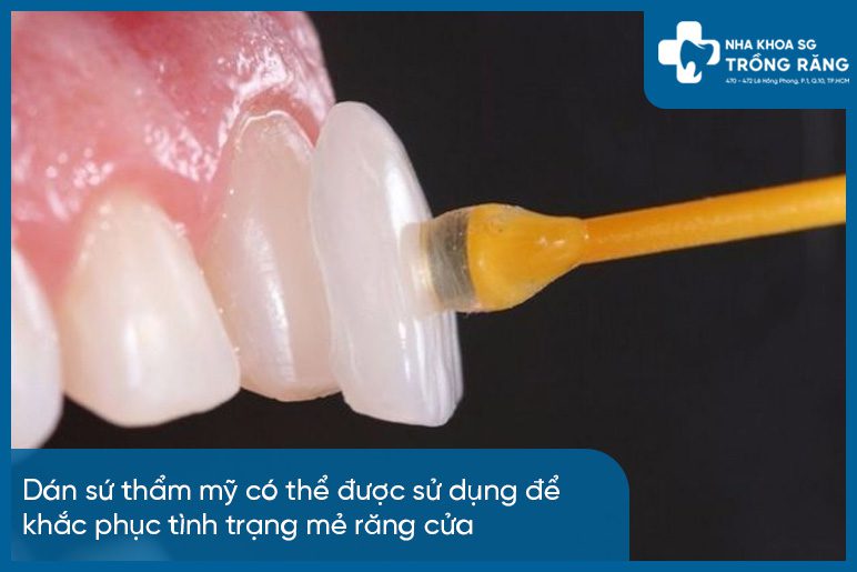 Khắc phục tình trạng răng cửa mẻ với mặt dán sứ