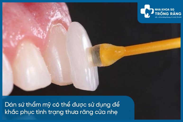 Khắc phục tình trạng răng cửa thưa với mặt dán sứ