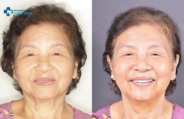 Khách hàng trồng răng implant tháo lắp