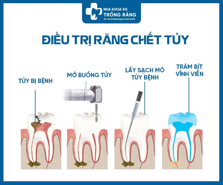 Kỹ thuật điều trị tủy và trám bít ống tủy