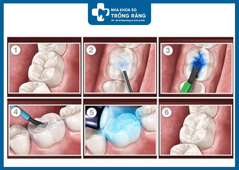 Kỹ thuật trám răng sâu
