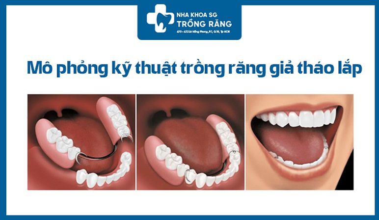 Kỹ thuật trồng răng hàm bằng răng giả tháo lắp