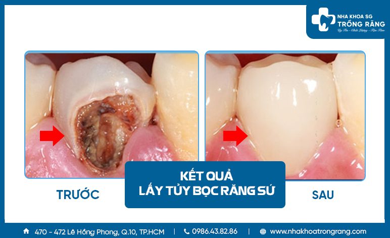 Lấy tủy bọc sứ cho thân răng bị hư tổn nặng