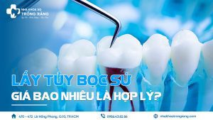Lấy tủy bọc sứ giá bao nhiêu