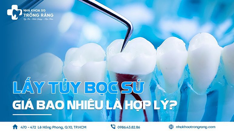 Lấy tủy bọc sứ giá bao nhiêu