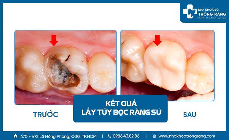 Lấy tủy bọc sứ răng sâu quá nặng