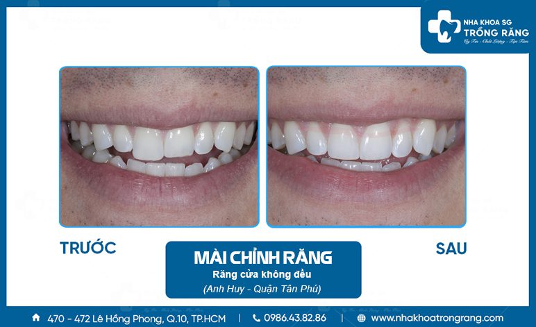 Mài răng cửa cho đều