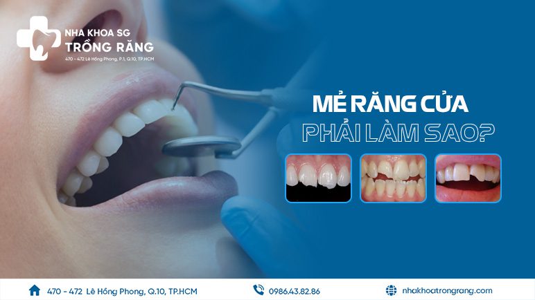 Mẻ răng cửa thì phải làm sao