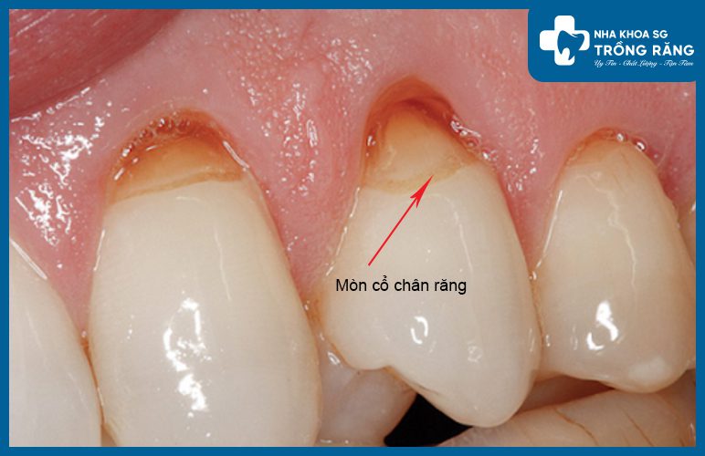 Mòn cổ chân răng