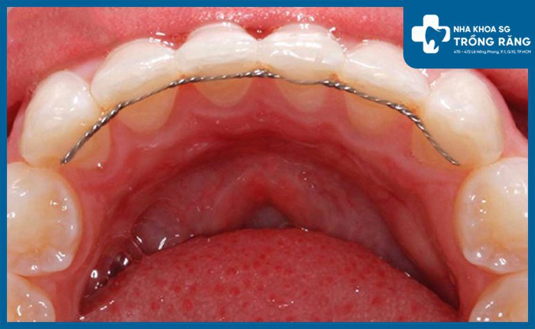 Nẹp cố định răng cửa lung lay Nẹp cố định răng cửa lung lay